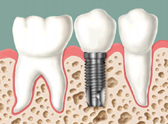 Implantes dentales Barcelona