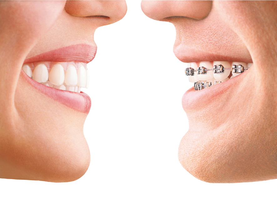 M0064 Invisalign en Clínica Dental Basi