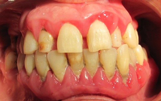 periodontitis 1 La periodontitis o enfermedad periodontal
