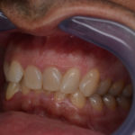 lateral Caso de ortodoncia (el antes y el después)