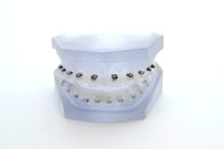 cementadoindirecto3 La mejor tecnología dental en Sant Feliu de Llobregat